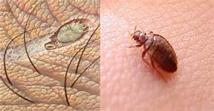 bed bugs or scabies
