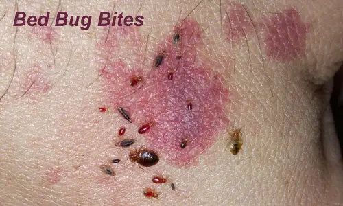 bed bug bite private part