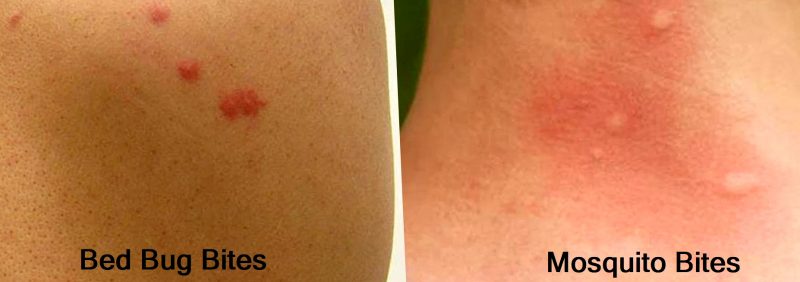 Bed Bug Bites vs. Mosquito Bites - Telling Them Apart